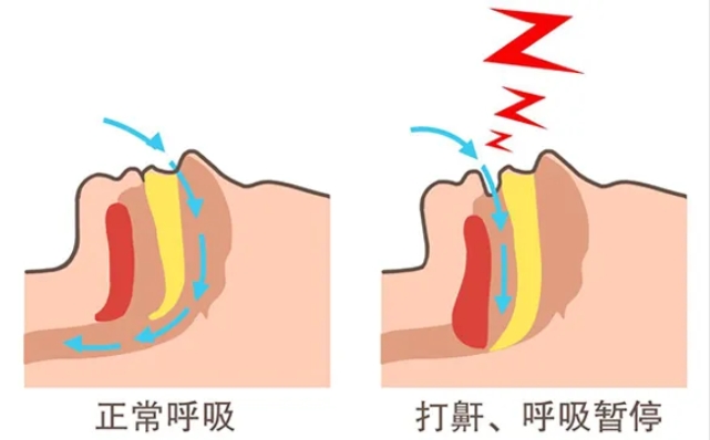 告别打鼾与慢性缺氧！无创呼吸机：10亿OSA患者的